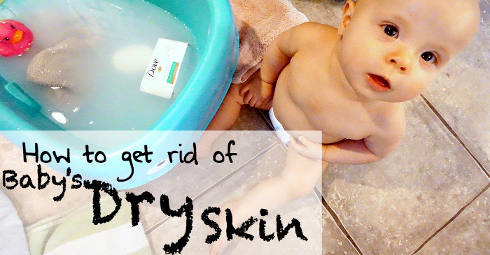 how to heal a baby's dry skin fb