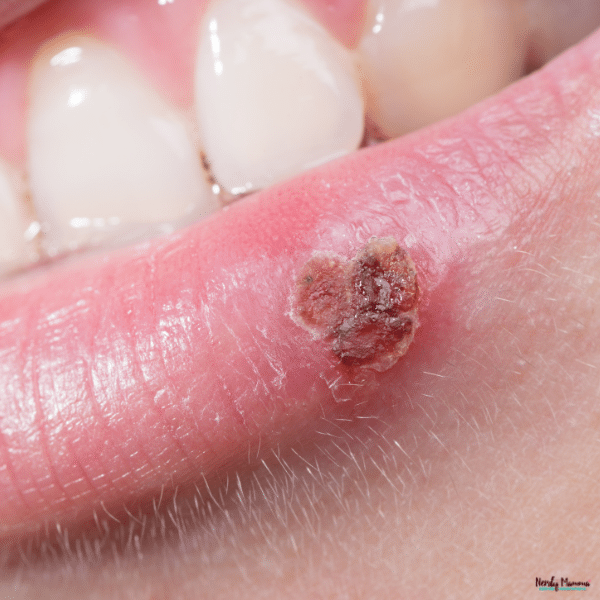 Close-up of a crusted cold sore on the lower lip showing redness and irritation around the affected area.